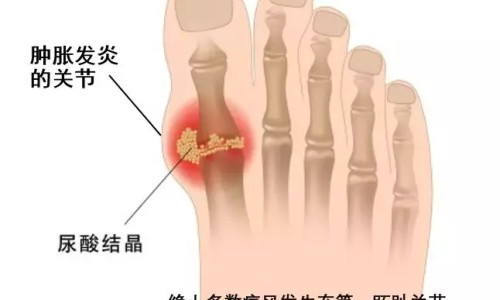 【肺结核病人嗜睡正常吗】肺结核病人发烧了怎么办 - 肺结核病人应怎样隔离网